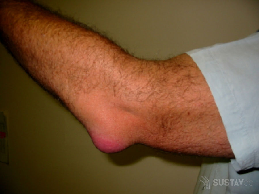 skausmas sąnario dėl pėdos kodėl skausmas pirštų sąnarių