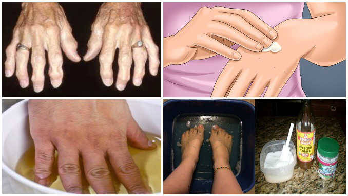 gydymas artritas ir artrozė rankų su liaudies gynimo pakuotės tepalas sąnarių artrozės metu