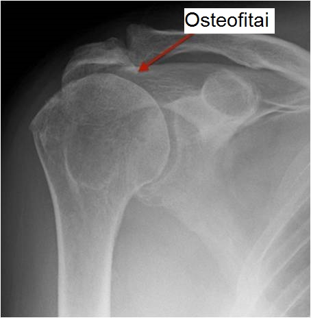 gydymas osteoartrito ir artrito peties sąnario norfa vaistine darbo laikas