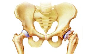 liaudies gynimo dėl artrozės gydymo plaukimo osteoartrito gydymui