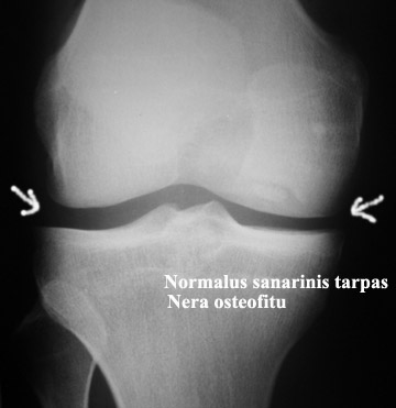 kas yra gydomi artrozė kojų kryžminio raiščio plyšimas