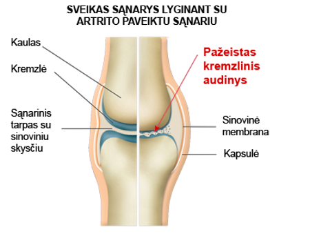 artritas viduriniosios piršto sąnarys ant rankų artrozė iš dešinės kojos sustav