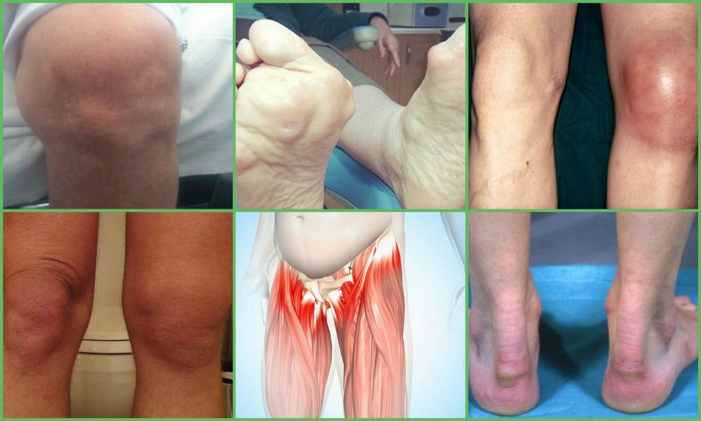 dislokacija bendrą pėdų gydymui artrozė iš alkūnės sąnario po lūžio