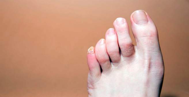 liga nuo pėdos pirštų sąnariai