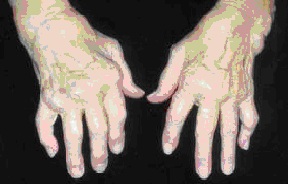 ligos nuo kaulų sąnarių rankas skauda bendra pečių ką daryti