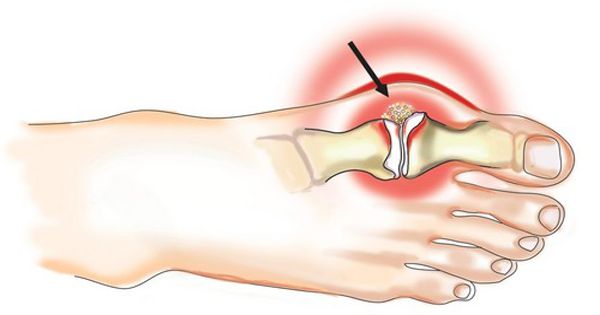 atsiliepimai apie osteoartrito pėdos gydymo artrozė gydymo šepečiai