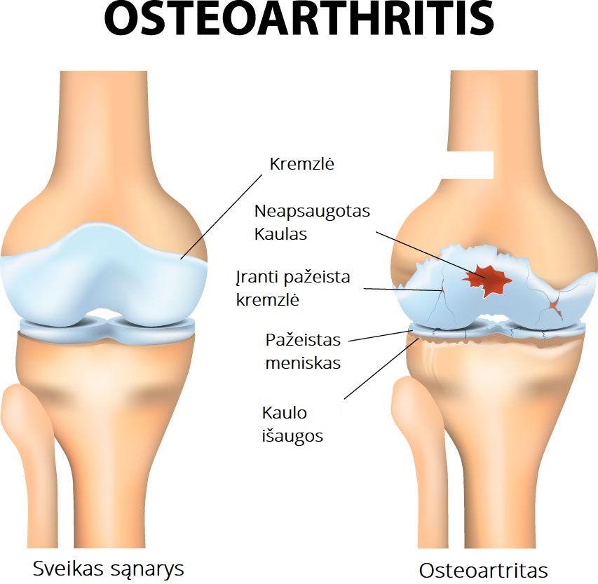 osteoartritas pozymiai artritas dešiniojo peties ginklų
