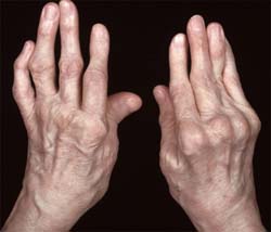 pašildyti peties sąnario artritas