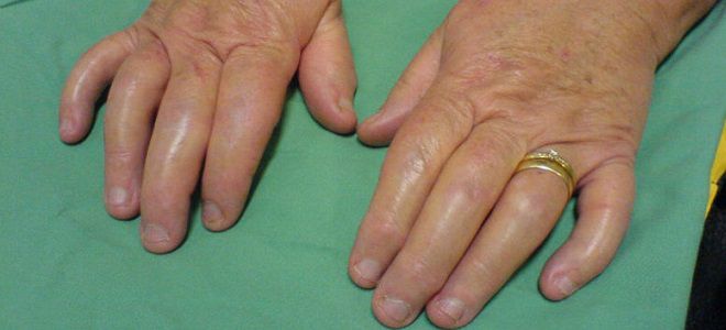 psoriazinis artritas simptomai pirmasis pirštas sąnarių skausmas