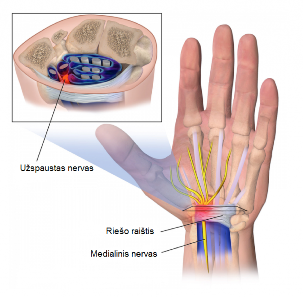 ranka išauga artrito vitaminai prieš sąnarių skausmas
