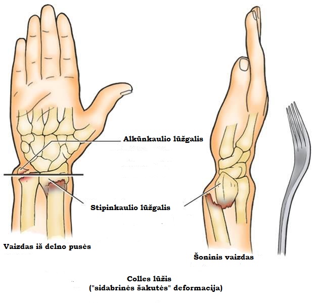 skauda rankos kaula gydymas osteoartrito ne pablogėjimą