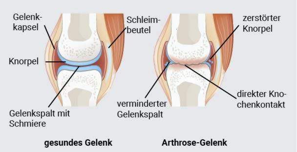 swelling painful joints sudden onset skauda peties sąnarys žalos