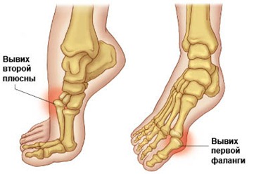 dislokacija bendrą pėdų gydymui įgimta artritiniu peties sąnarys