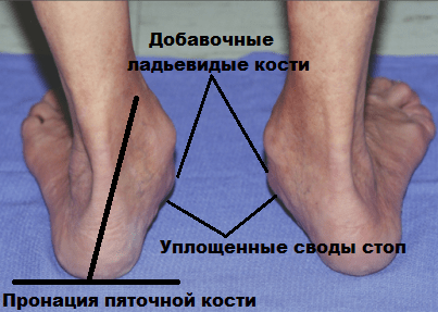 1-2 laipsnių artrozės gydymo pėdų