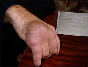 artropatijos sąnarių šepetėliai rankos gydymas gydymo iš rankų teptuko sąnarių namuose