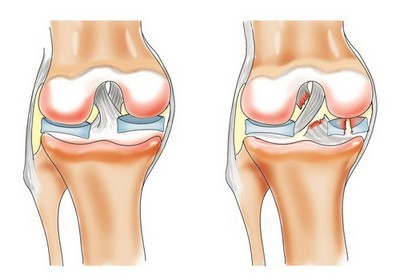 swelling painful joints sudden onset tepalas skausmai piršto sąnarių