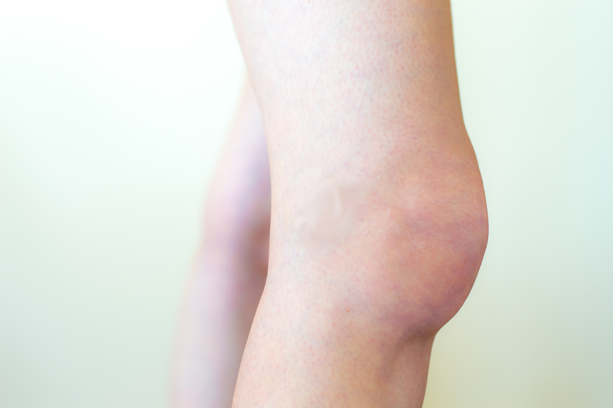 edema in knee joint