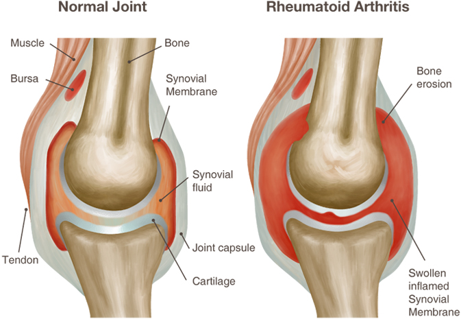 reumatoidinis artritas stadijos