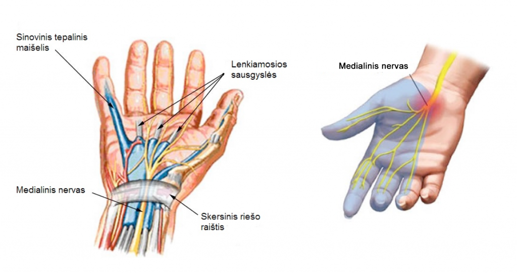 ranka išauga artrito puodai sujungimų