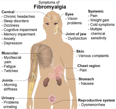 fibromialgija skausmas