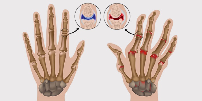reumatoidinis artritas yra traktuojami mazi nuo sąnarių uždegimo rankų