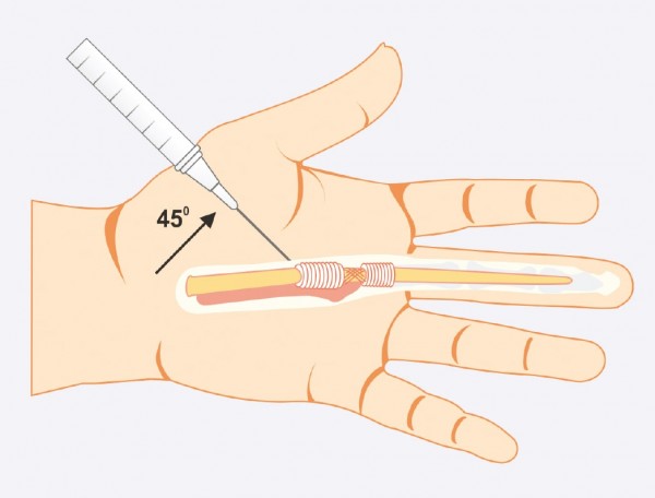 ligonių bendra ant piršto rankų gydymui gerklės sąnarių ant piršto