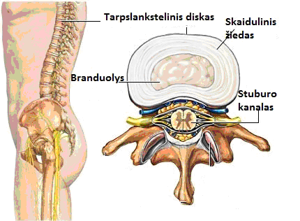 priemonės osteochondrozė nikofleks tepalas nuo osteochondrozės