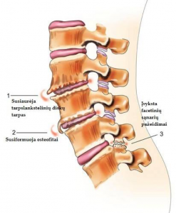 osteochondrozė stuburo bolshes sąnarių ir kaulų