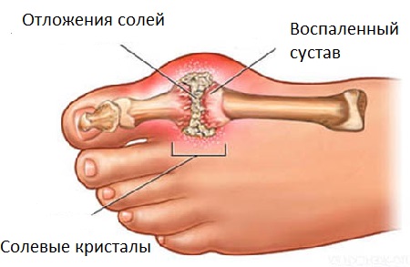 artrito rankas pasekmės