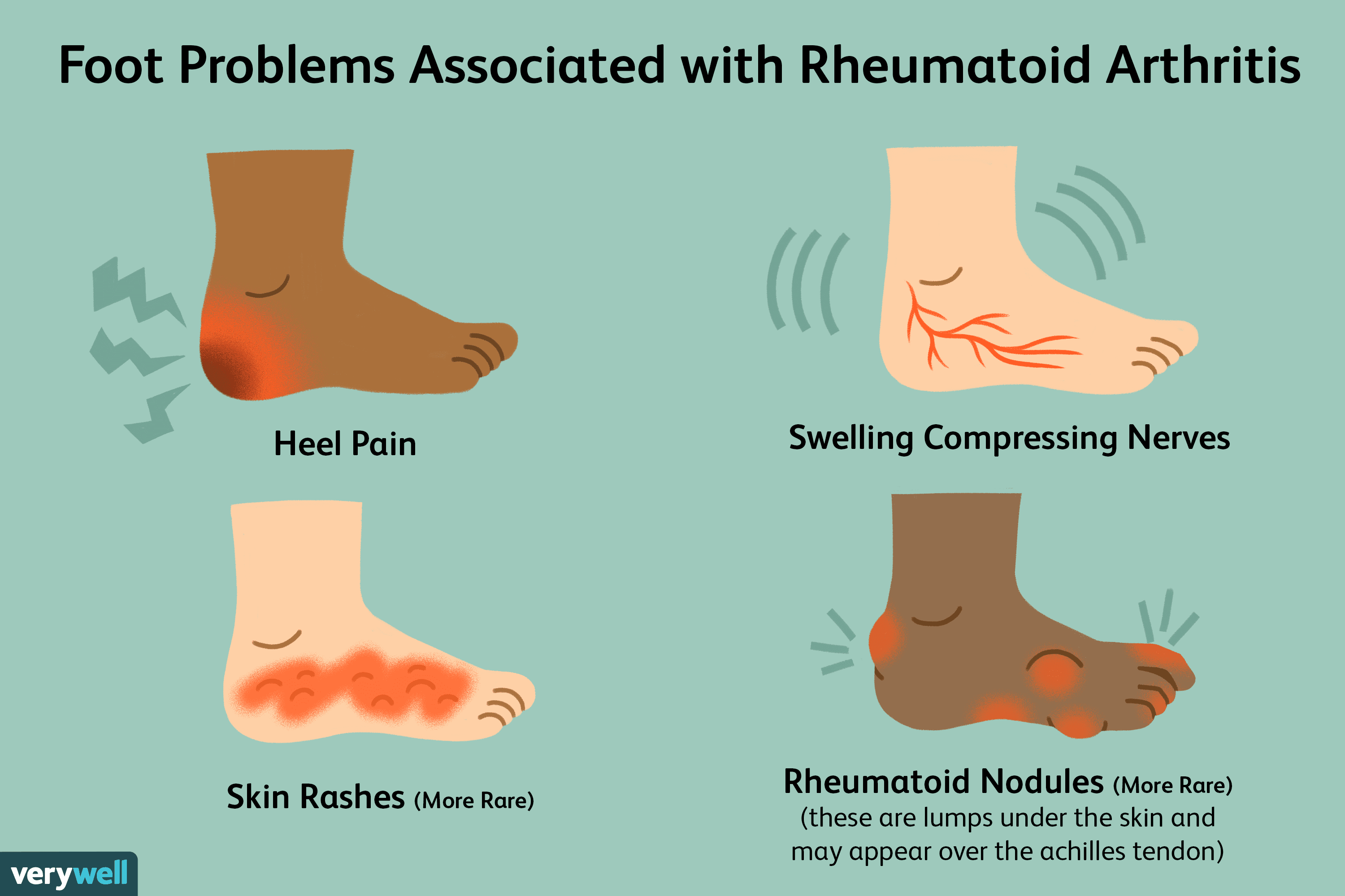 swollen painful foot joints