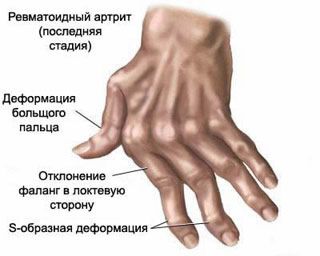 rankų išsipučia priežastis ir skausmas rankų sąnarius ilgai skauda pirštu po traumos krūvą