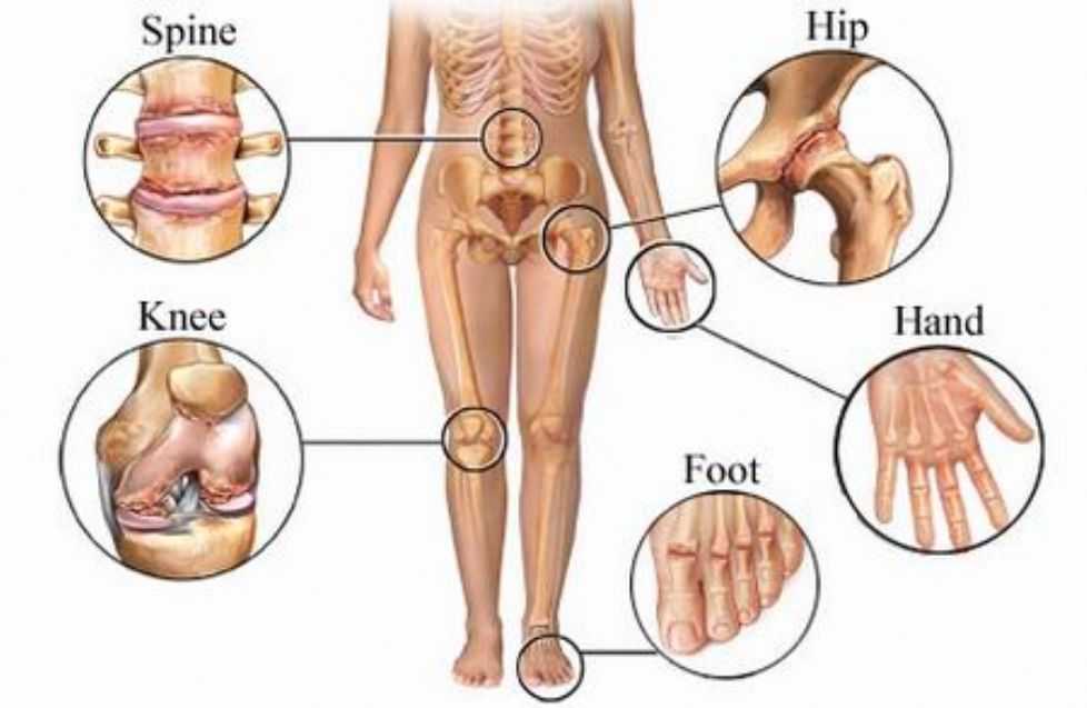 artrozė sąnarių kam susisiekti artrozės 3 laipsnių pėdos gydymas
