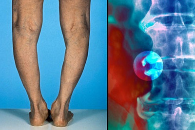 atsiliepimai apie osteoartrito pėdos gydymo skauda sąnarius šepečiai iš to ką