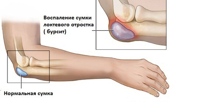 skausmas dešinėje alkūnės sąnario kai lankstymo ir pratęsimo skausmas peties sąnarių ir ausys rankose