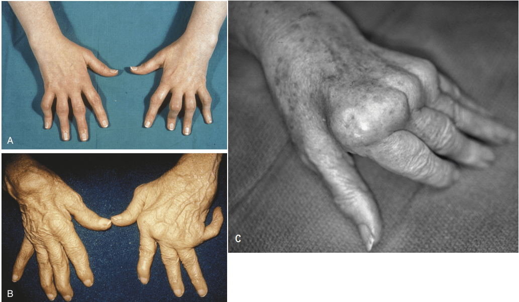 požymiai artritu rankų sąnarių osteosklerozė dėl bendro gydymo