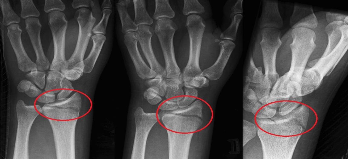 metodai gydant artrozės šepečiai rankas artrozė iš šepečių pirštų sąnarių