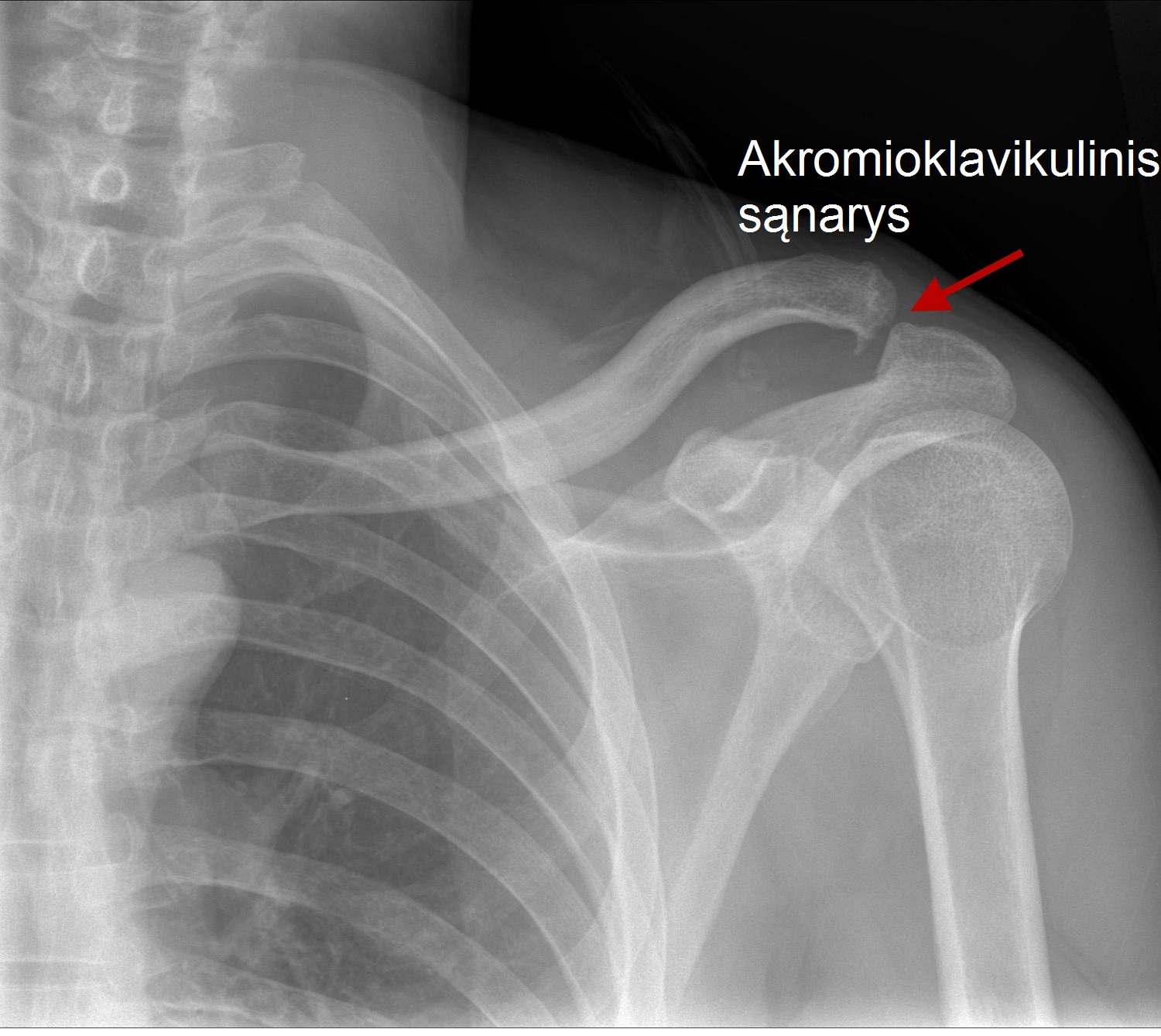 artrozė iš kairiojo peties gydymui skausmas nugaros sąnarių