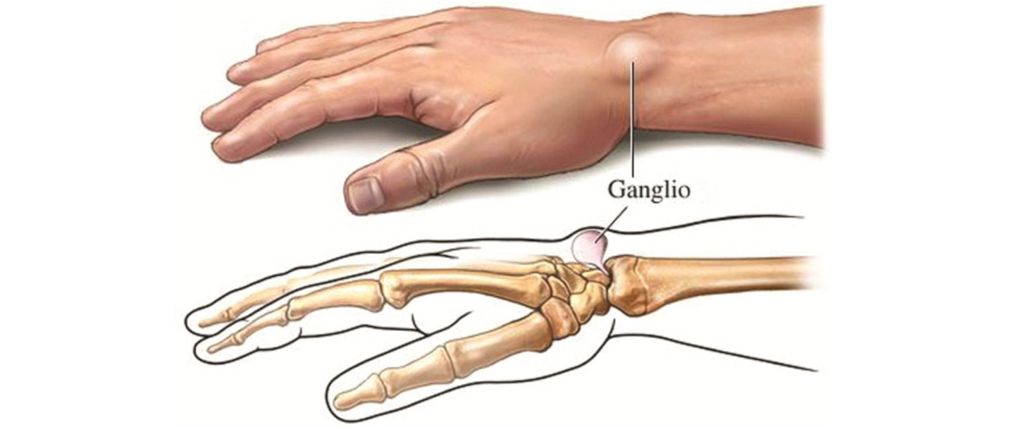 artritas rankos valymo atsiliepimai gydymas nuo šlaunikaulio lūžio