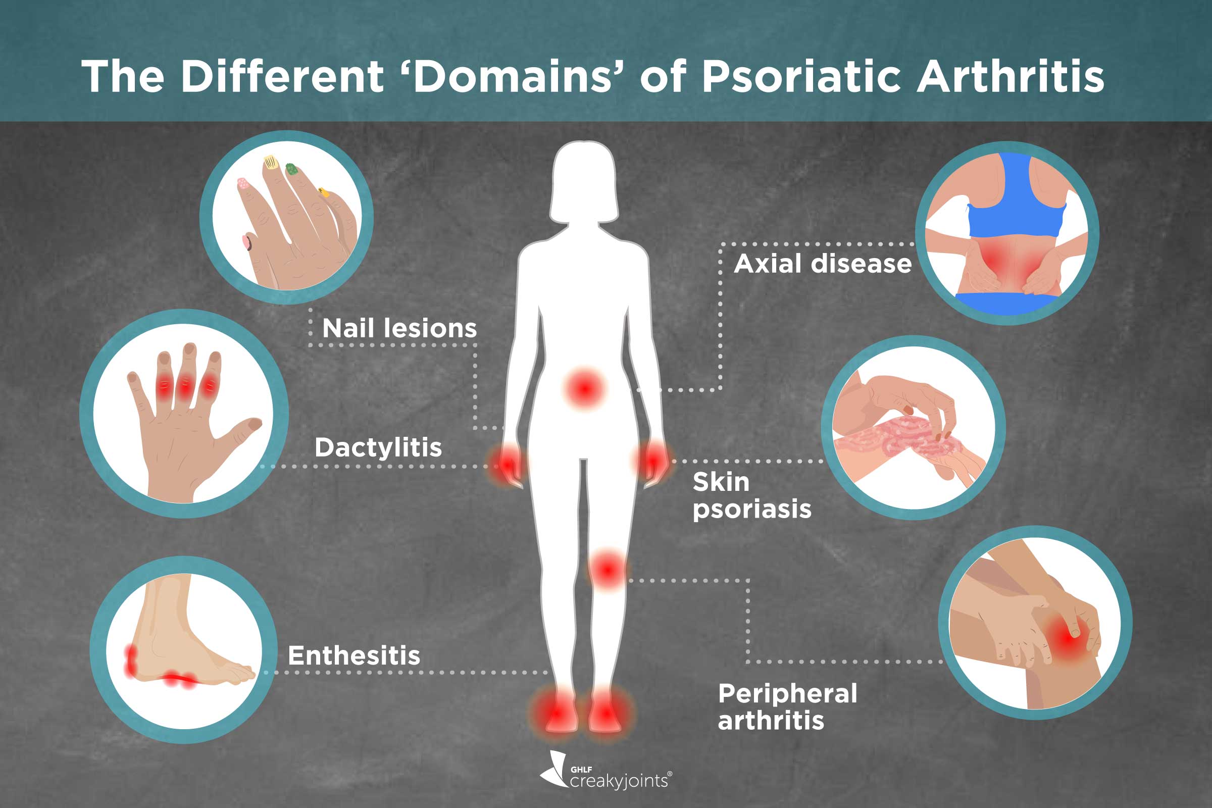 psoriasis artritas simptomai geliai ir kremai sąnarių atsiliepimus