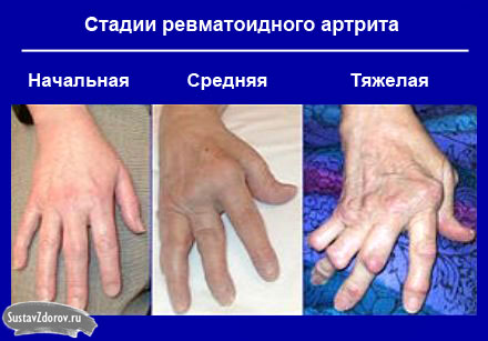 artritas prieš artrozės gydymo fone sąnarių skausmas pomoshch
