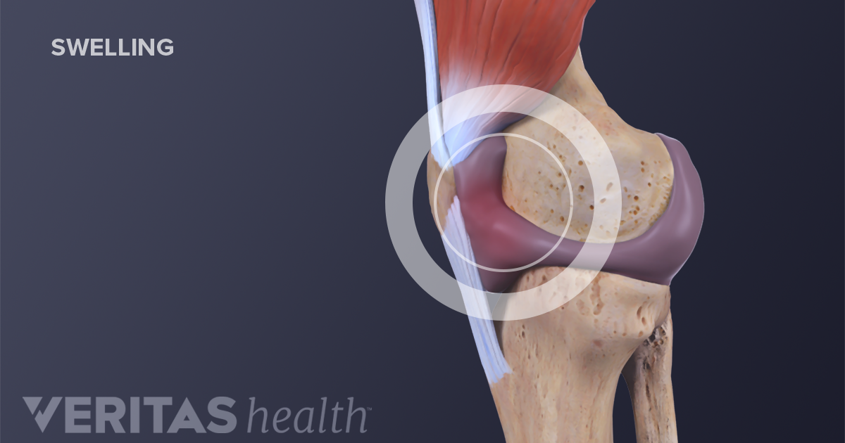 edema in knee joint