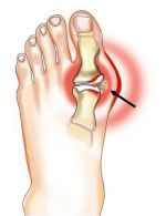 gydymas uždegimas pėdų sąnarių tipai artrito rankų
