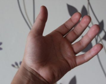 gerklės bendra nykščio ant rankos ką daryti artrozė artritas sustava