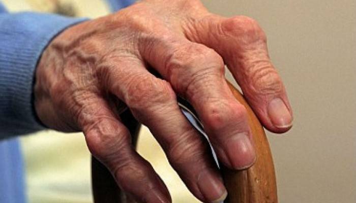 gydymas osteoartrito rankų šepetys liaudies gynimo
