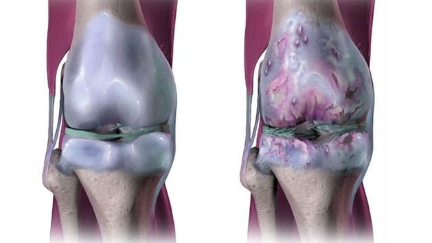 kojos rieso skausmas artrozė nykščio pėdos gydymas liaudies gynimo