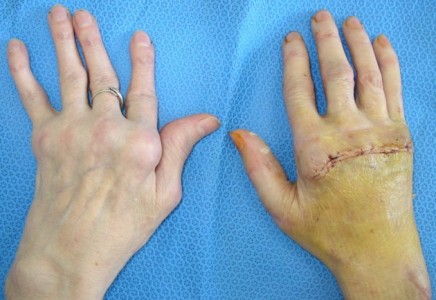 ligonių bendra ant piršto rankų gydymui po insulto skauda rankas sąnariai