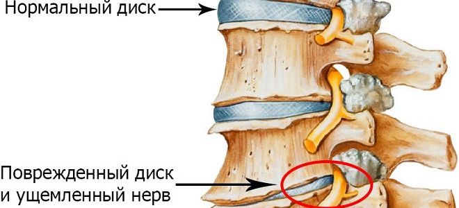 osteochondrozė kas tai artritas vikipedija