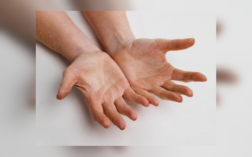 rankos peties sanario skausmas