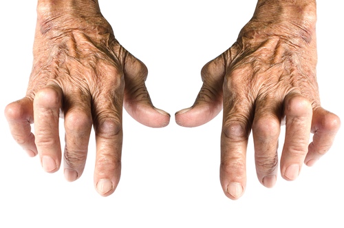 reumatoidinis artritas yra traktuojami sugauti skausmas peties sąnario