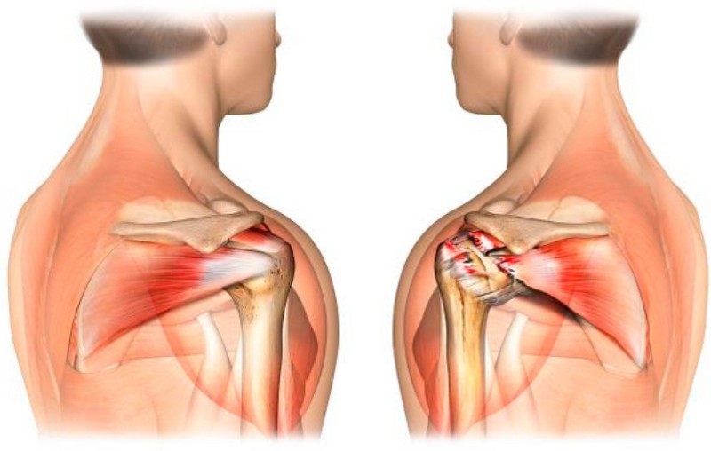 skauda pečių jungtiniame ką daryti riešo skausmas